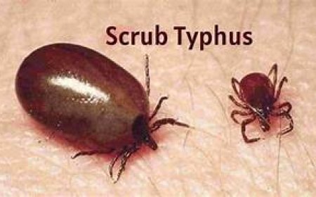 ସ୍କ୍ରବ ଟାଇଫସ୍‌: ବଲାଙ୍ଗୀରରେ ୩୩୭ ଆକ୍ରାନ୍ତ ଚିହ୍ନଟ